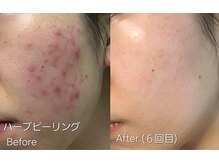 マロン(MARON)の雰囲気（ハーブピーリング/頬ニキビ/肌質改善/毛穴ケア）