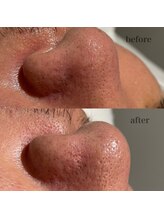 シャルム ド ケー(charme de k)/最強毛穴洗浄