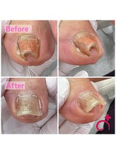 Dr.巻き爪 天神院/60代女性！仕方のない事だと。