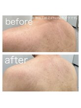 ラクシー 北千住(luxssy)/お背中シェービング