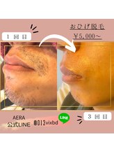 アエラ(AERA)/お髭【光脱毛】変化がすごい！