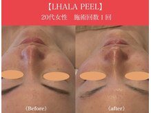 リプロ(RePro)/ララピール　ビフォーアフター