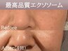 【小顔/リフトアップ】エアーインジェクション＋高品質エクソソーム（60分）