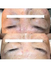 フィエルテ(Fielte)/シワ/シミ/たるみ/毛穴