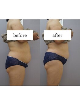 アップルミント/＜痩身＞before・after