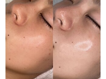 ヴィータ(VITA)/韓国肌☆水光生美容液ピーリング