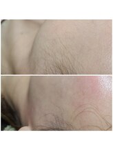 ウォーマル(warmaL)/フェイシャルワックス脱毛