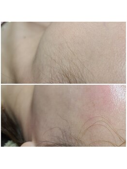 ウォーマル(warmaL)/フェイシャルワックス脱毛