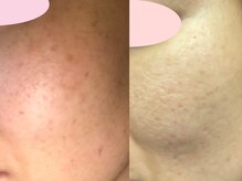 エヴェリーナ(Eveliiina)/43歳★8回シミケア