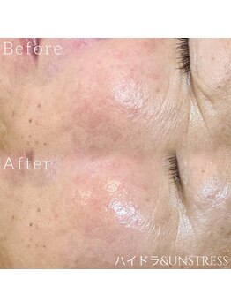 ルチル 八女店(Rutile)/シワができる理由の一つ