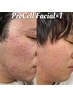 ◆初回カウンセリングから◆凹凸のある肌に◎最新肌ケアプロセルセラピーズ