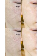 ミント(mint)/#毛穴洗浄 #ハーブピーリング