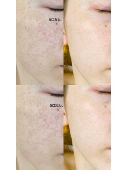 ミント(mint)/#毛穴洗浄 #ハーブピーリング