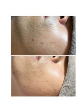 ジョルフ サロン オリジナル(JOLF salon original)/ヒゲ脱毛