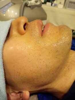 ミライズ(MIRAI'S)/ヒゲの青みが消えトーンアップ♪