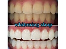 ホワイトニングショップ 鳥取店/ホワイトニングビフォーアフター