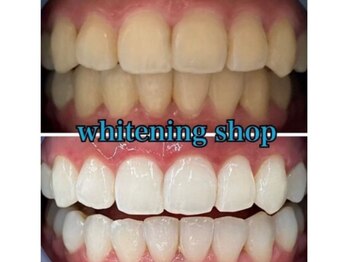 ホワイトニングショップ 鳥取店/ホワイトニングビフォーアフター