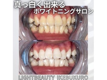 ライトビューティー 池袋店(LightBeauty)/症例写真