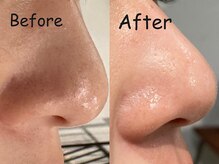 アトリエ オリーブの雰囲気（毛穴洗浄xお顔剃りで毛穴に詰まった汚れ・古い角質除去◎）