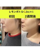 ララチッタ(L'la citta)/レモンボトル2cc