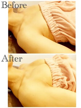 ロココ 豊田店(Rococo)/ビフォーアフター(下垂・ハリ)