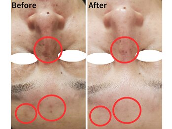 サロン ド ボーテ プルーラ(Salon de beaute PLURA)/シミケアはじっくり時間をかけて