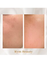 リム ビューティー(RYM BEAUTY)/お肌のシミケアやくすみにも