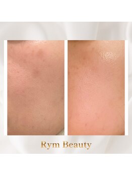 リム ビューティー(RYM BEAUTY)/お肌のシミケアやくすみにも