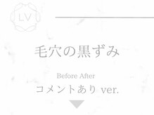 ラヴィオーラ 栄(LV)/ダイヤモンドハーブピーリング