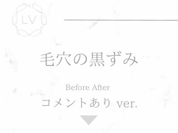 ラヴィオーラ 栄(LV)/ダイヤモンドハーブピーリング