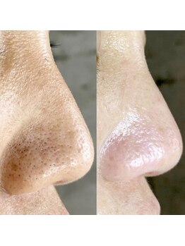 アーフ(ARF)/肌質改善