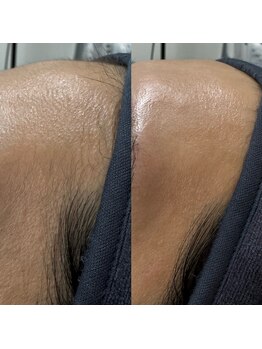 コリー(Kolly)/おでこの産毛が、、、