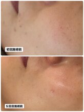 リコス(LICCO’S)/光フォト　シミケア4回