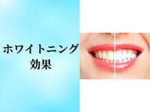 ベルホワイト(Belle White)/ホワイトニング　Before★After