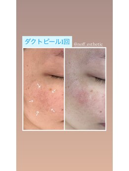 ノフ 恵比寿(noff)/bf/af【ダクトピール】