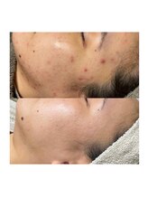 ルアラナ(Lualana)/お手入れを始めて3年目の変化