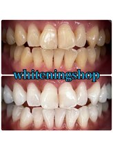 セルフホワイトニング専門店　 ホワイトニングショップ船橋2号店【ホワイトニング】/Before&After美白ホワイトニング