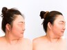 【小顔 + 小顔矯正】吸引やリフト→何度も戻る方。二重アゴを解消したい