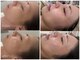 マホロバ(mahoroba)の写真/【自律神経、首肩こり、疲労】韓国漢方よもぎ蒸し＋鍼灸&漢方オイルで疲れをリセット★巡り改善