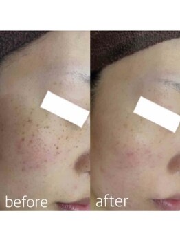 ブランシェ 高岡店 × 椿/シミケア『30代お客様』