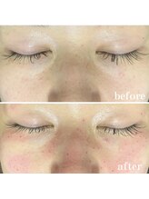 キビック(KIBIK)/【シミケア 照射直後】