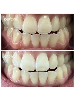 エクシアホワイトニング 津駅前店/お客様ビフォーアフター