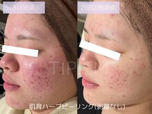 ハービー(Herbee)/赤ら顔にも