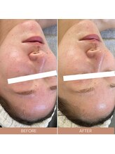 ルルーディア(LOULOUDIA)/毛穴スッキリ！赤ら顔も改善♪