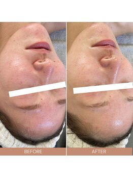 ルルーディア(LOULOUDIA)/毛穴スッキリ！赤ら顔も改善♪