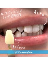 ホワイトニングカフェ 池袋東口店/ホワイトニングビフォーアフター