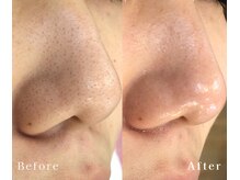 リノ(Lino)/毛穴の黒ずみ除去