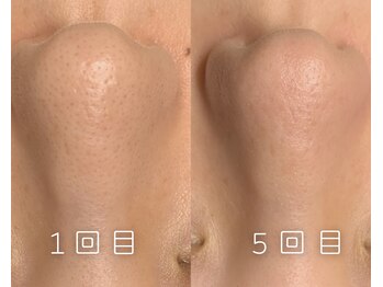 リブレ(LIBRE)/韓国式3D毛穴洗浄