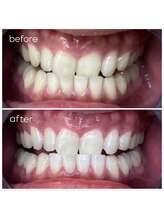 エクシアホワイトニング 津駅前店/お客様ビフォーアフター