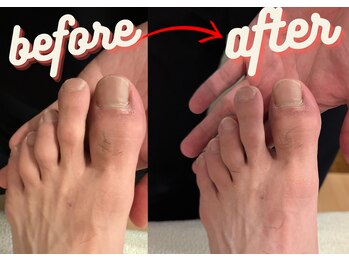 マーレ(MARE)/足の親指の変形、腫れに対して